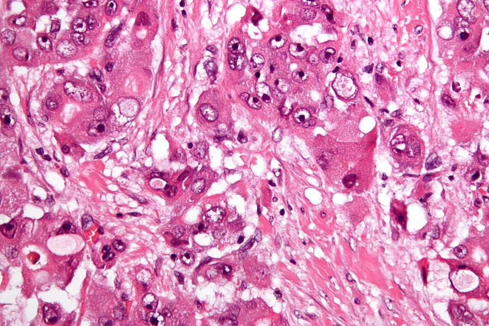 Fibrolamellar_hepatocellular_carcinoma_-2-_very_high_mag